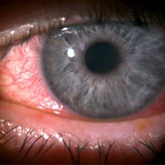 Eye Irritations - Aaron Optometrists